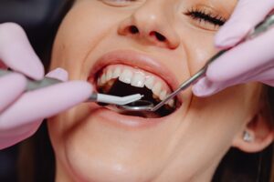 bleeding gums