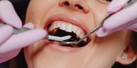 bleeding gums