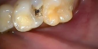 cavity-1a
